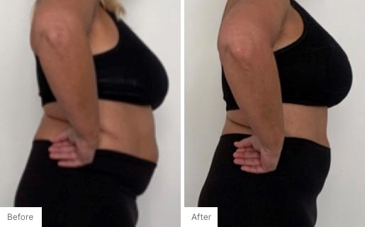 10 - Before and After of a woman's body using NeoraFit.